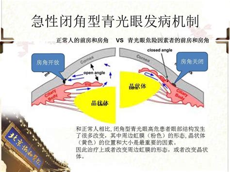 房角|闭角型青光眼